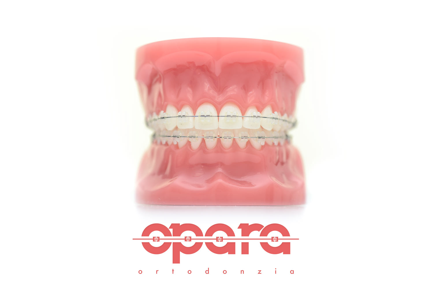 Ceramic braces