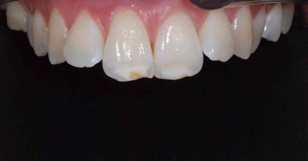 fluorosi denti Pinerolo